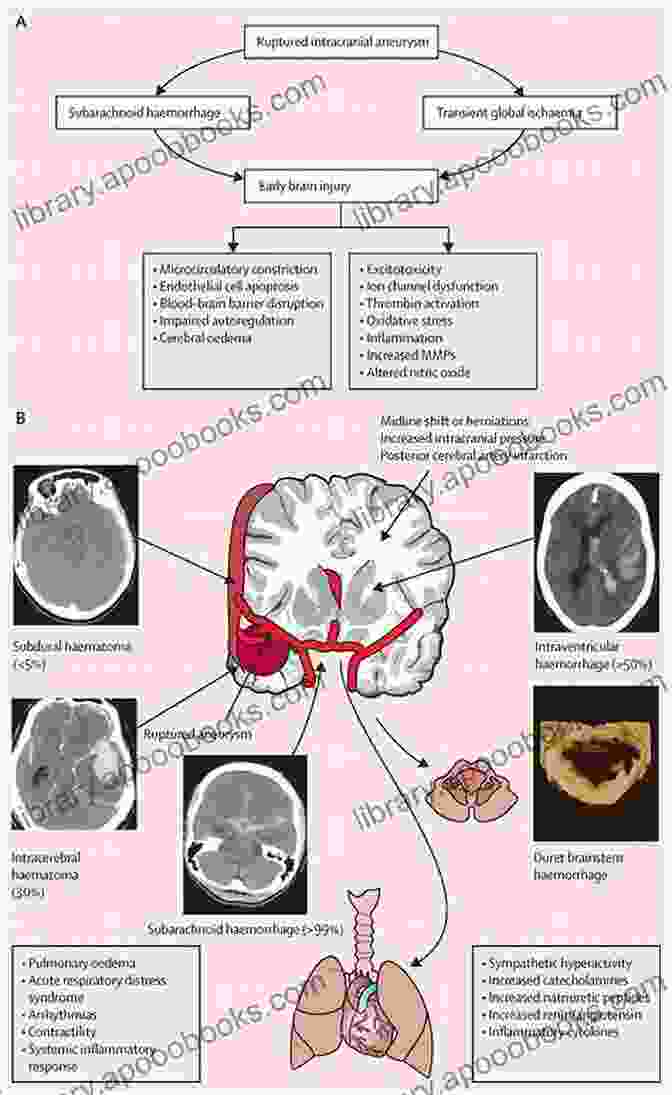 Pathophysiology Of Subarachnoid Hemorrhage Management Of Subarachnoid Hemorrhage John D Rothschild