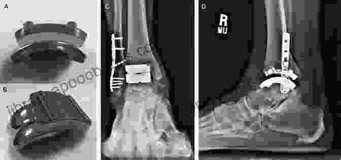 Revision Total Ankle Replacement: An Issue Of Clinics In Podiatric Medicine And Surgery Revision Total Ankle Replacement An Issue Of Clinics In Podiatric Medicine And Surgery (The Clinics: Orthopedics 30)