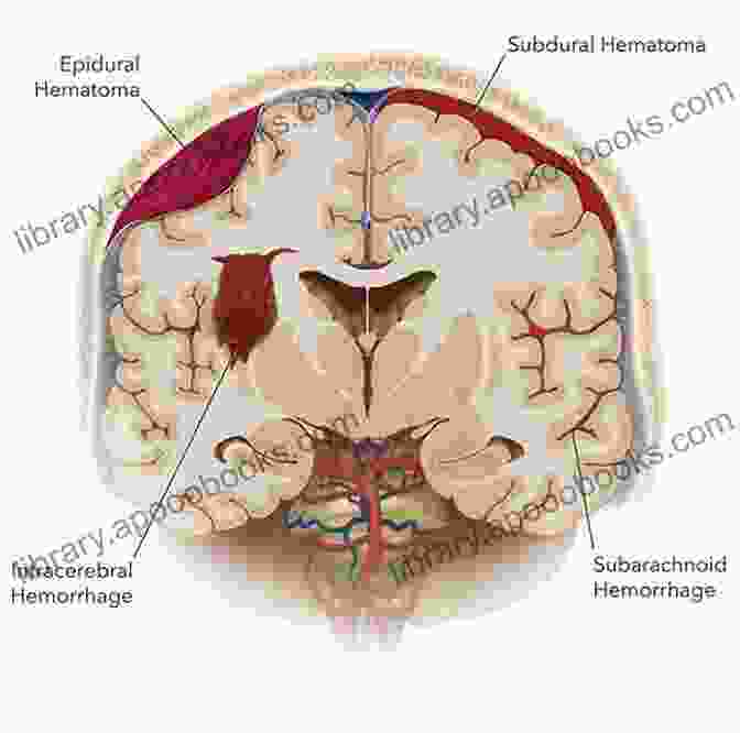 Surgical Interventions For Subarachnoid Hemorrhage Management Of Subarachnoid Hemorrhage John D Rothschild