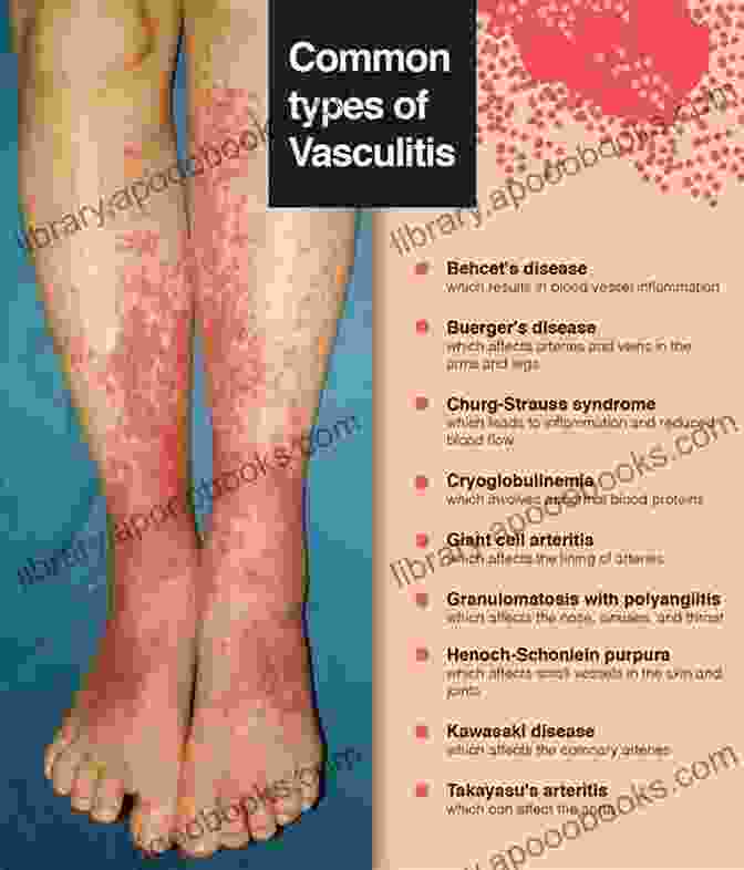 Vasculitis, An Autoimmune Disease Affecting Blood Vessels Rheumatology MCQs For NEET SS Series: 2: Vasculitis